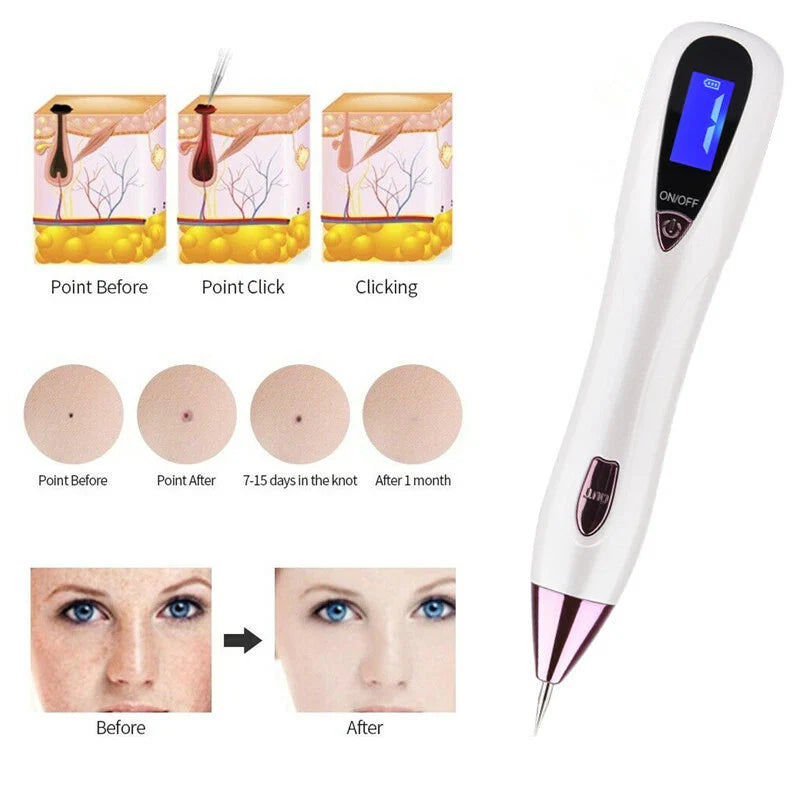 Plasma Pen Skin Tag & Dark Spot Remover | Anti-Aging Beauty Tool