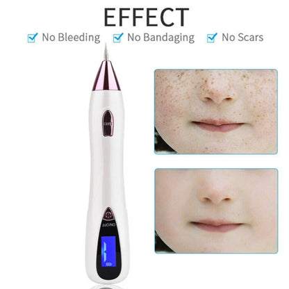 Plasma Pen Skin Tag & Dark Spot Remover | Anti-Aging Beauty Tool